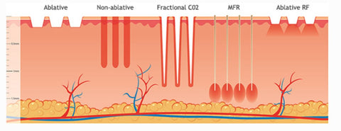 Fractional CO2 Laser Singapore To Treat Face Scar Removal | Aesthetic Medical Clinic