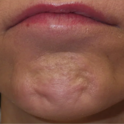 Nasolabial Folds | Chin Wrinkles | Causes and Treatments | How to Fix 