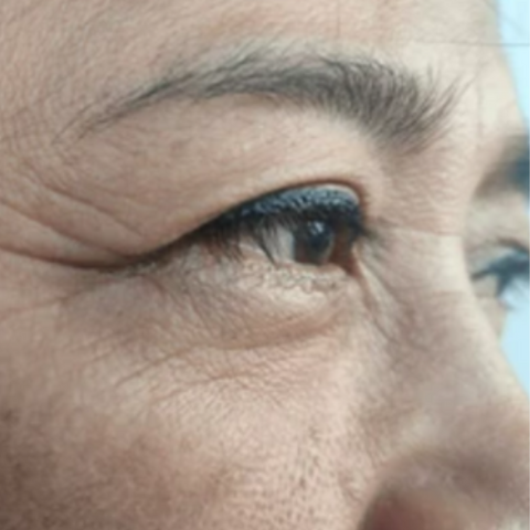 Nasolabial lines | Crow's Feet are wrinkles that form around the outside of the eyes over time