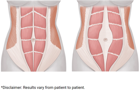 Abdominal Separation Image | IMAGO Aesthetic Wellness