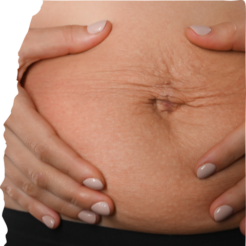 Does Diastasis Recti Fully Heal | IMAGO Aesthetic Wellness