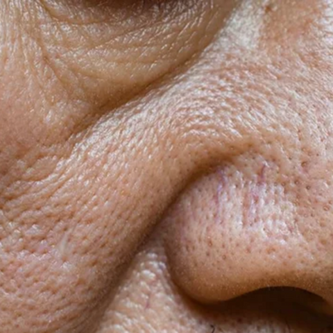Enlarged Pores | Makeup, sweat, and dirt are the biggest culprits when it comes to clogged pores which can result in the appearance of large pores