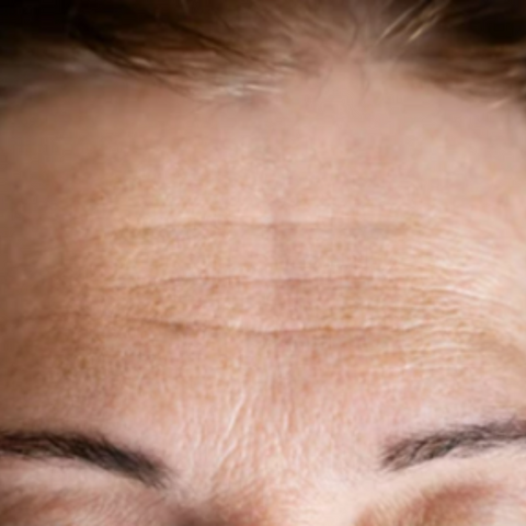 Nasolabial fold | Forehead wrinkles are a normal part of aging and are due to the loss of collagen | IMAGO Aesthetic Clinic