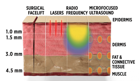 HIFU Ultraformer 3 comparison with other technology