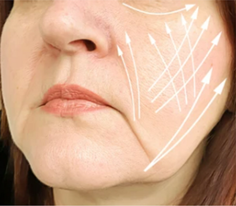 HIFU Ultraformer 3 Skin Treatment
