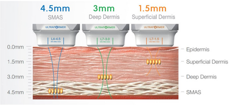 HIFU Lifting facial using different depth of hand applicator for different penetration