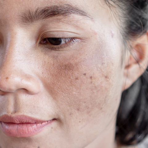 Skin Hyperpigmentation Treatment