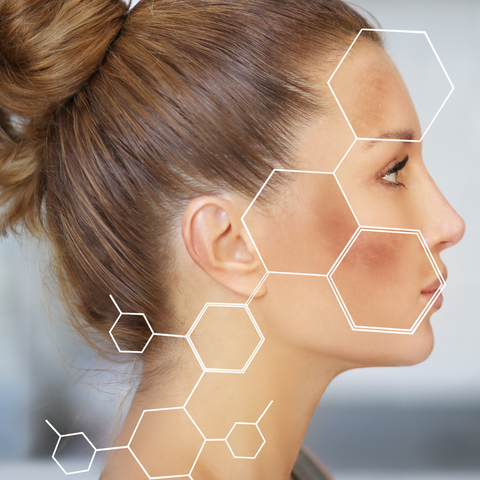 Melasma Removal Treatment by Skin Doctor Singapore