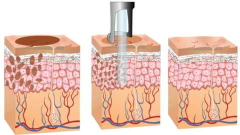 Laser Clinic Singapore | Pigmentation Removal Laser