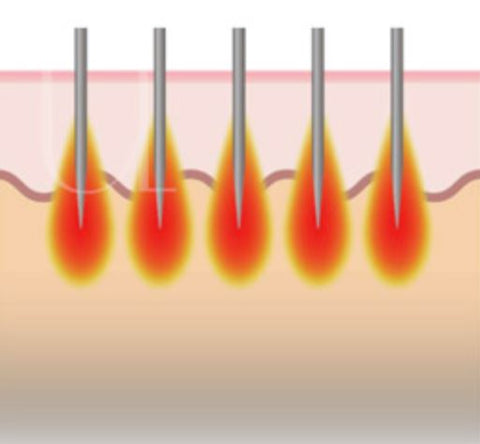 Micro Needle RF with Sylfirm X Review and Sylfirm X Treatment Price | Aesthetic Singapore