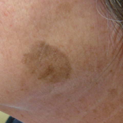 How to Get Rid of Solar Lentigines | IMAGO Aesthetic Clinic