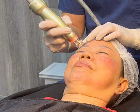 Sylfirm-X | Dermatologist applying topical cream for active acne treatment on a patient's face.