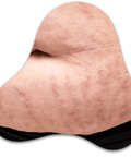 Stretch Marks Removal (RF Microneedling) - IMAGO Aesthetic