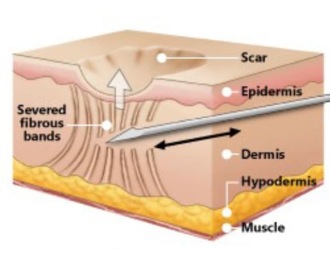 Subcision Acne Scar Removal with Laser Treatment Singapore