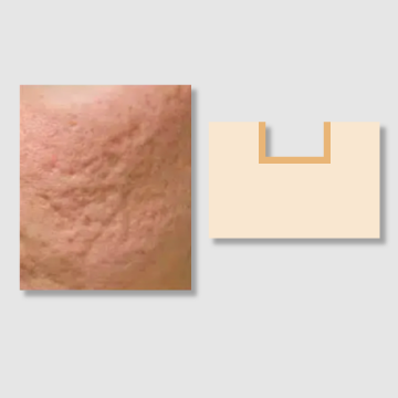 BOXCAR Scars | How to Get Rid of Scars: Treatments and Home Remedies | IMAGO Aesthetic Clinic