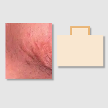 Hypertrophic Scars: Acne Scar Removal & Treatment By Best Aesthetic Clinic Singapore