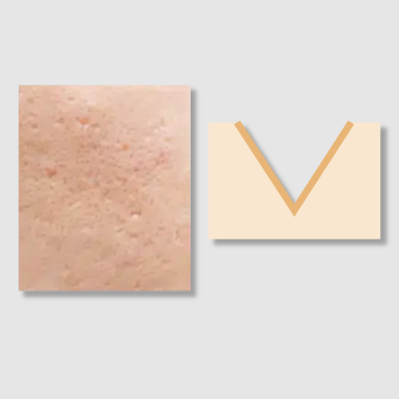 ICEPICK Scars Treatment | Best  Aesthetic Clinic Singapore