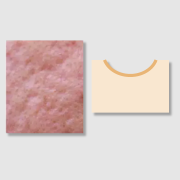 Rolling Scars - Acne Scars: Treatment, Removal, and More By IMAGO Aesthetic Clinic