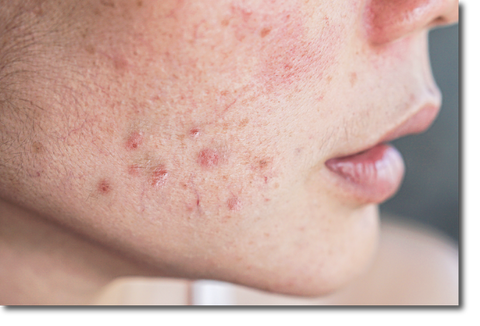 Acne Scar and Pimples : Causes, Diagnosis, Types & Treatment by IMAGO Aesthetic Clinic in Singapore