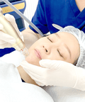 RF Microneedling Treatment for Acne Scar Removal - IMAGO Aesthetic Clinic