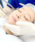 RF Microneedling Treatment for Acne Scar Removal - IMAGO Aesthetic Clinic