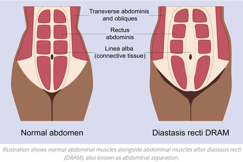 What is Abdominal Separation | Mummy Pooch Singapore