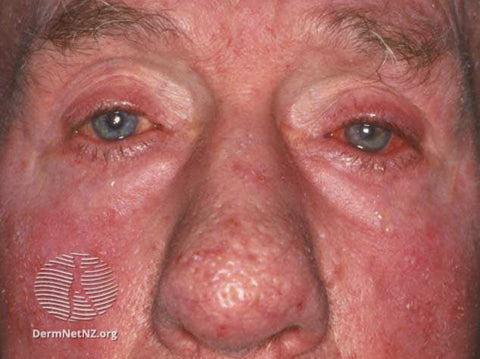 Rosacea Therapy for Eye Treatment Singapore | Medical Aesthetic Laser Clinic 