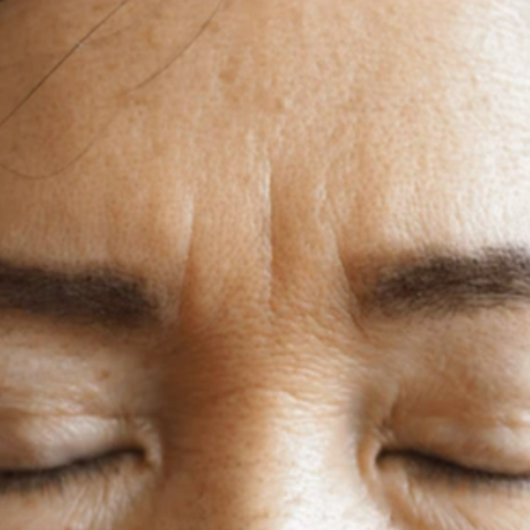 Nasolabial lines | Frown Lines | Patient receiving a non-surgical skin tightening procedure to combat signs of aging
