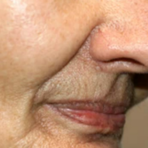 Aging Face | Nasolabial Folds (Smile Lines) | Causes and Treatments Singapore