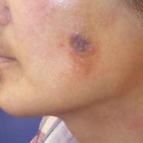 What is Post Inflammatory Hyperpigmentation (PIH) | IMAGO Aesthetic Clinic