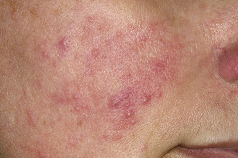 Rosacea Treatment in Singapore with Pimple scar before and after | IMAGO Aesthetic Clinic Singapore