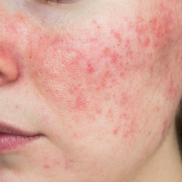 Rosacea Treatment Price Guide 2024 Treat Redness on Face IMAGO