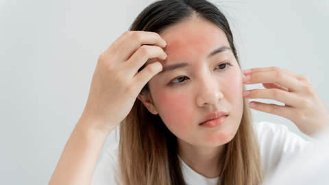 Rosacea Treatment Price Guide 2024 | Treat Redness on Face - IMAGO Aesthetic