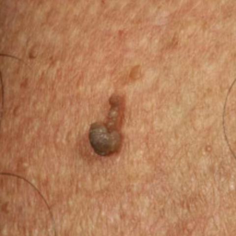 How to Eliminate Skin Tags | IMAGO Aesthetic Clinic