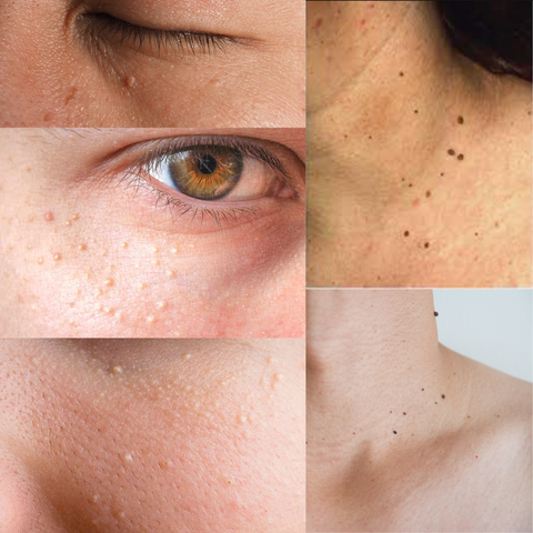 Skin Tag Milia Seeds Oil Clog Removal Singapore by IMAGO Skin Care Clinic Singapore