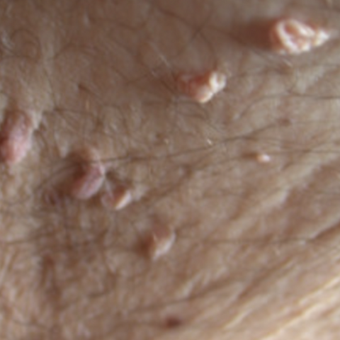 Skin Growth or Skin Tags on Neck