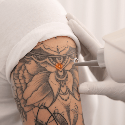 Tattoo Removal Cost Near Me | IMAGO Aesthetic Clinic