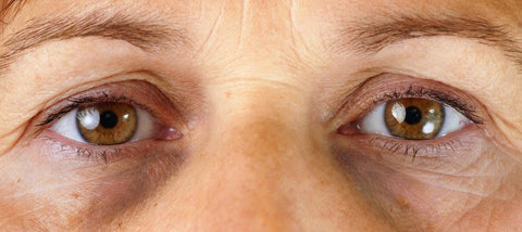 Dark Eye Circles Vascular Congestion | Treatments and Causes of Vascular Dark Circles