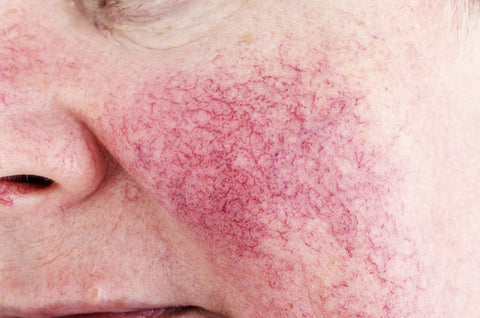 Rosacea Triggers for Rosacea Skin | Rosacea Therapy for Rosacea Redness Treatment