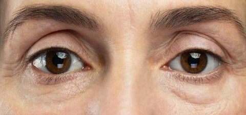 Dark Eye Circles | Volume Loss and Skin Laxity | Causes and Treatments