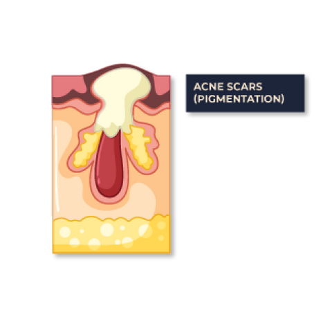 Face Scar Pigmentation Treatment Singapore | Aesthetic Singapore