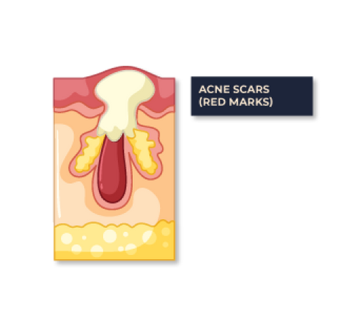Acne Scars Pimple Scars Skin Treatment Singapore | IMAGO Aesthetic Clinic Singapore