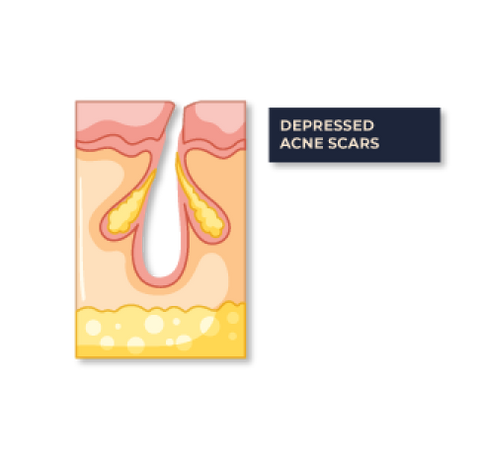 SCARS FOR FACE SKIN TREATMENT SINGAPORE