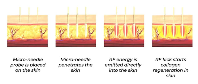 Anti Aging RF Microneedling | Treat Multiple Skin Concerns - IMAGO ...