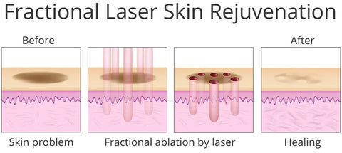 how fractional skin resurfacing works